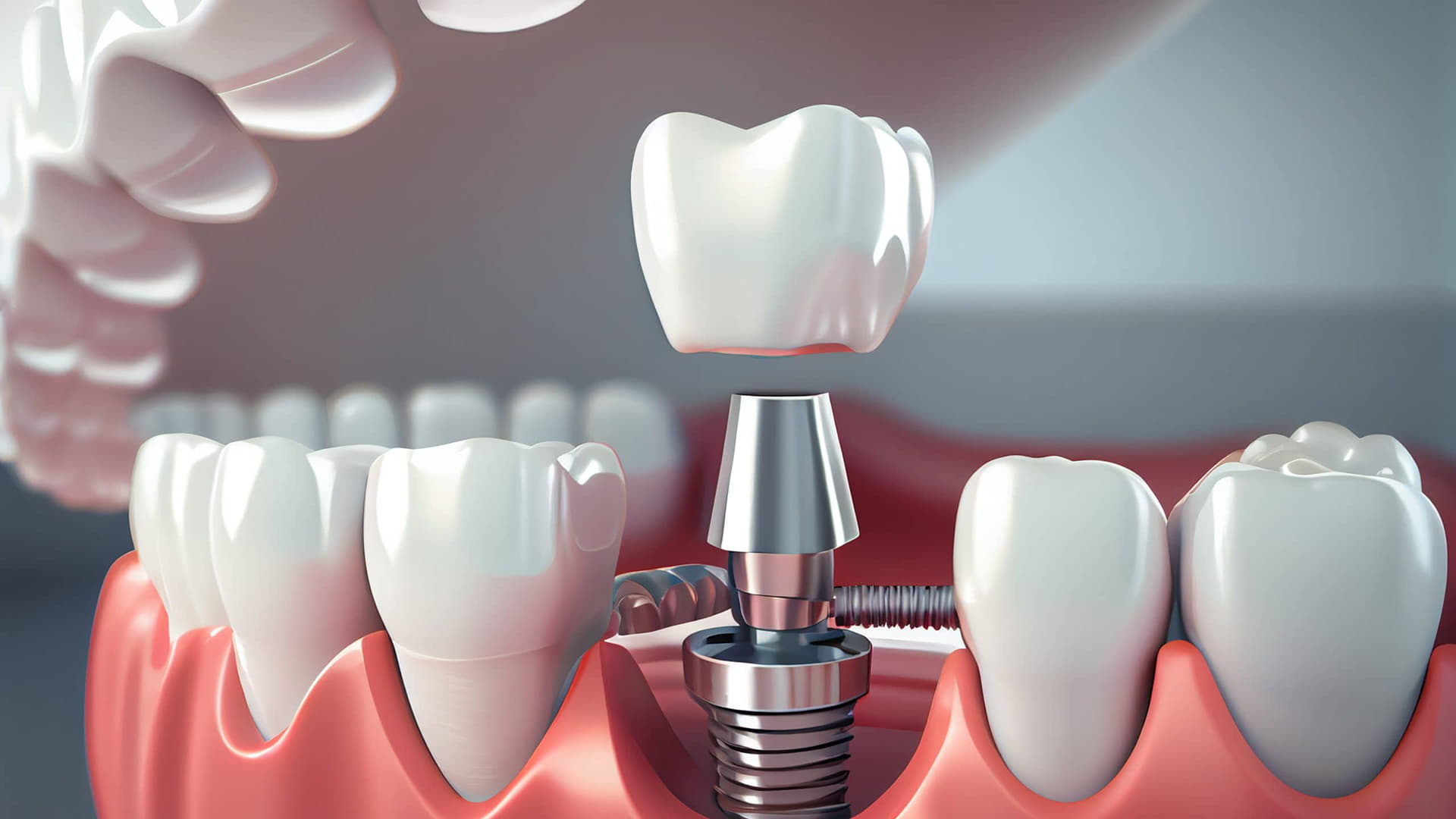 Dentist - Dental Implants - img
