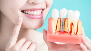 Meet your Dental Implant Dentist_1