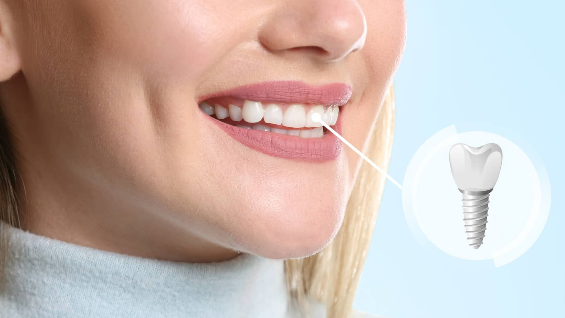 Sedation for Dental Implant Procedure